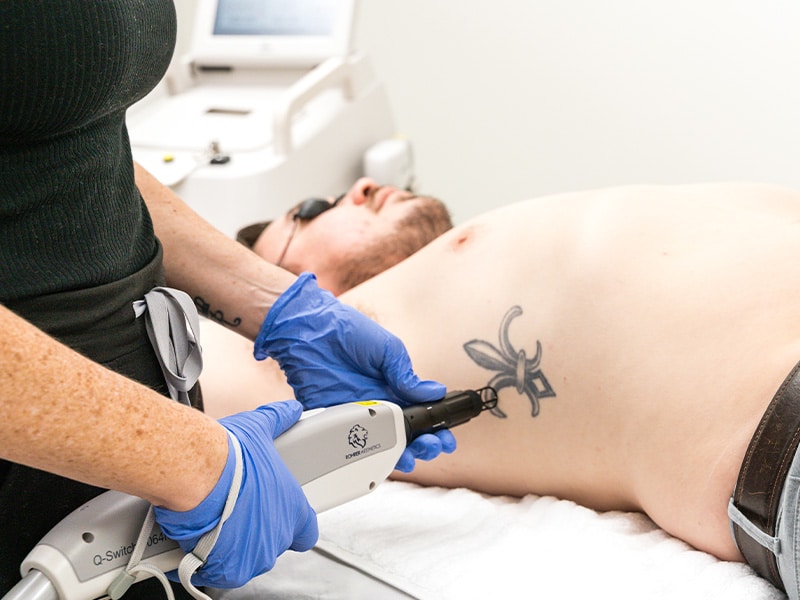 Saline Tattoo Removal vs Laser Tattoo Removal | Removery